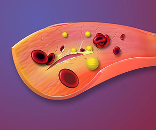 Damaged Artery Wall